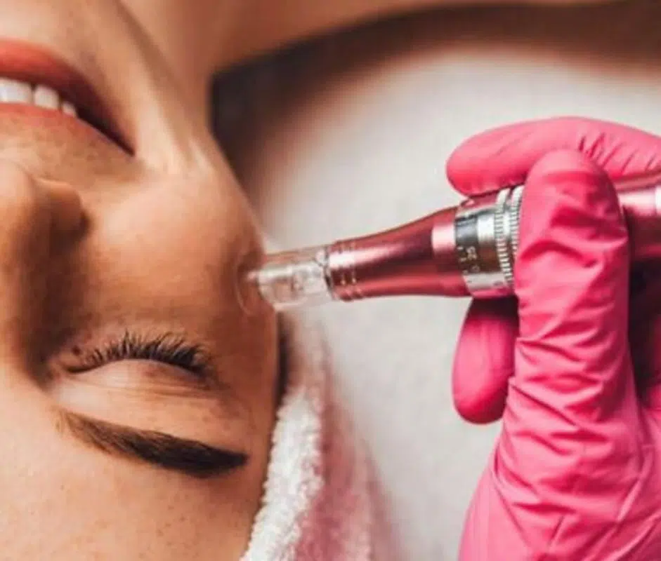 Formação Microagulhamento Facial & Corporal